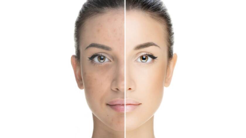 hyperpigmentation skin