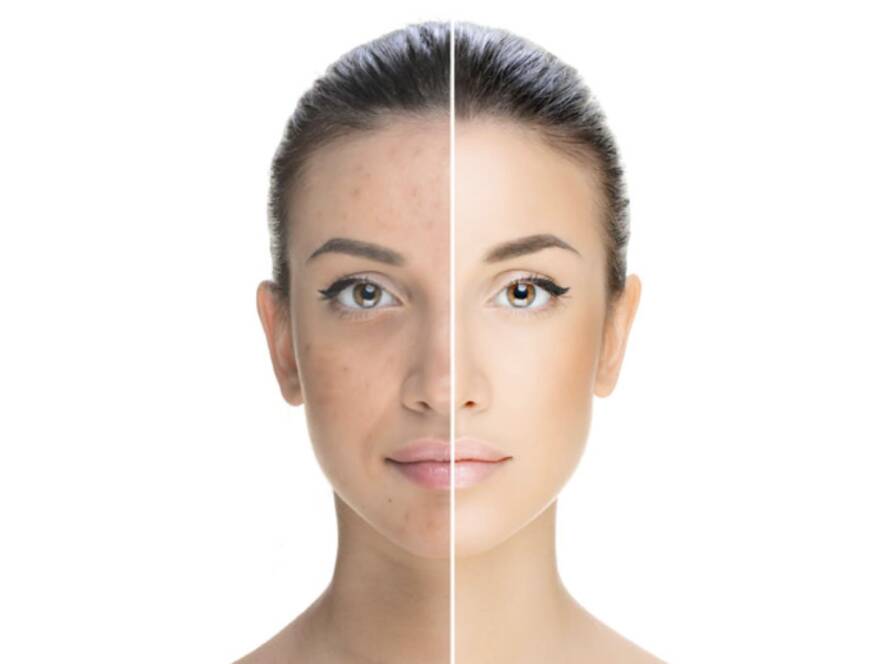 hyperpigmentation skin